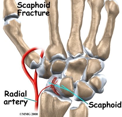 Scaphoid Fracture of the Wrist