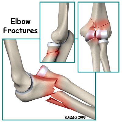 Adult Elbow Fractures