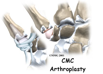 Artificial Joint Replacement of the Thumb - Performance Physical Therapy & Rehabilitation Services Guide