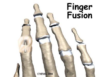 Finger Fusion Surgery - Performance Physical Therapy & Rehabilitation Services Guide