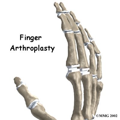 Artificial Joint Replacement of the Finger - Performance Physical Therapy & Rehabilitation Services Guide