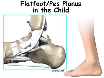 Congenital Flatfoot (Pes Planus) in Children