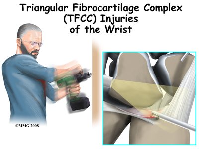 Triangular Fibrocartilage Complex (TFCC) Injuries