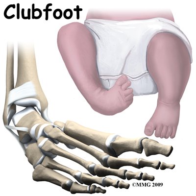 Guide to Clubfoot