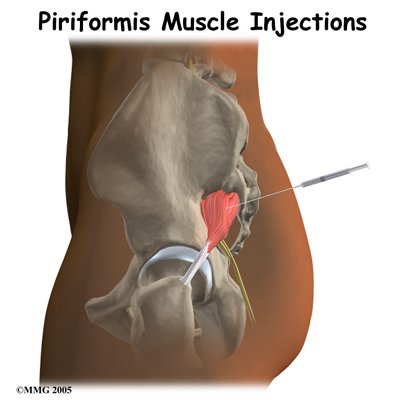 Piriformis Muscle Injections