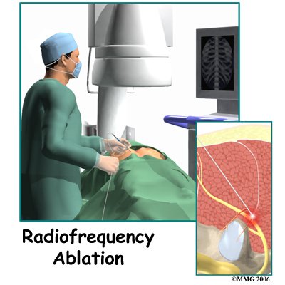 Radiofrequency Ablation