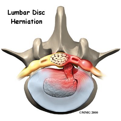 Lumbar Disc Herniation