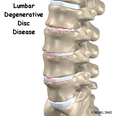 Lumbar Degenerative Disc Disease